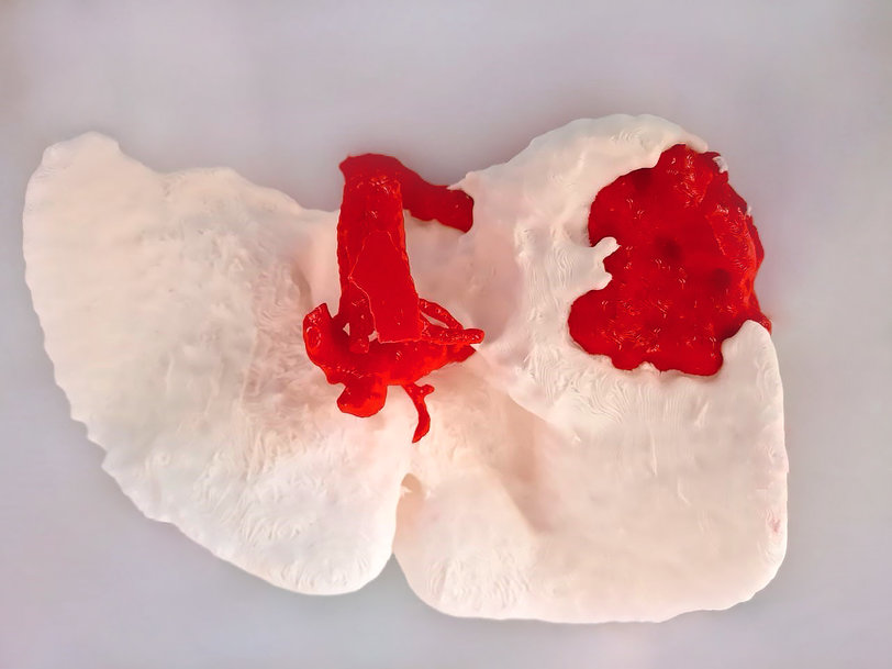 BCN3D's 3D printing technology creates biomedical models that improve cancer surgeries